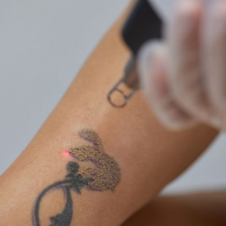 Tattoo-Removal